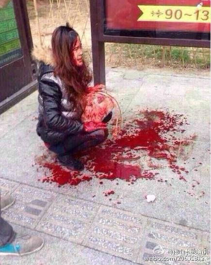 称一名女子在大沥江夏村公交站被人抢手袋,被砍伤双手