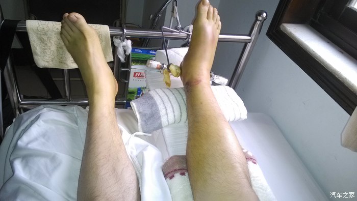 双腿骨折后,宝马 越野 摩托什么都是浮云!